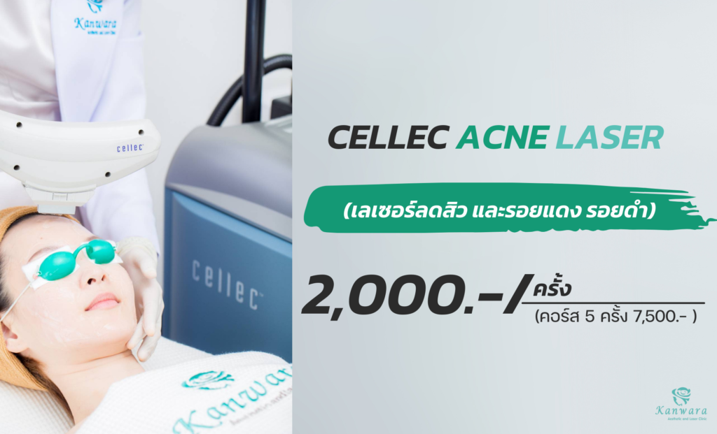 เลเซอร์หน้าใส